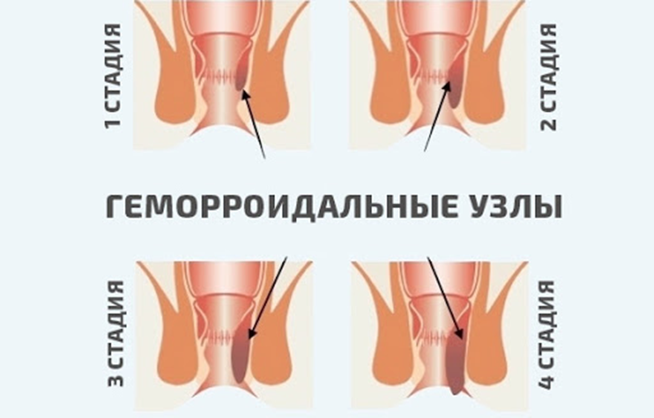 Геморроидальные узлы