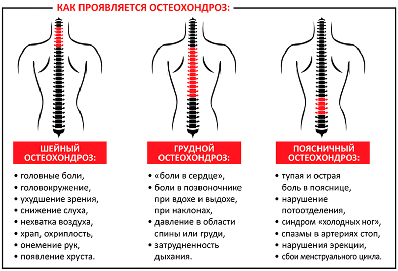 Лечение остеохондроза