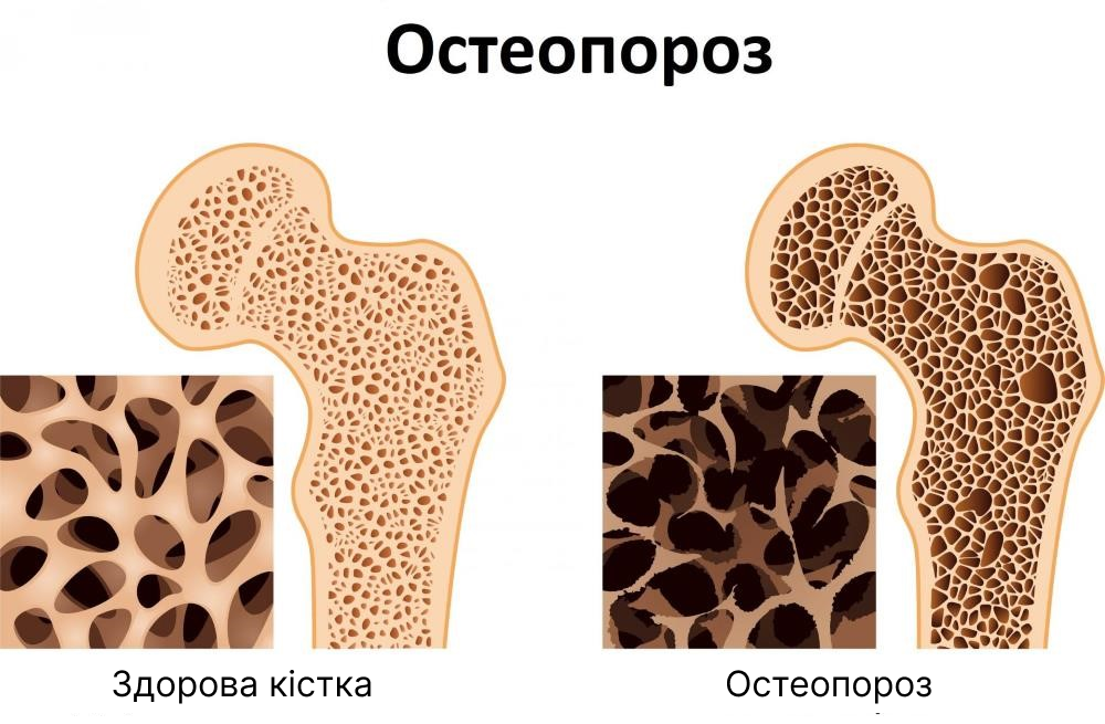 Причини виникнення остеопорозу