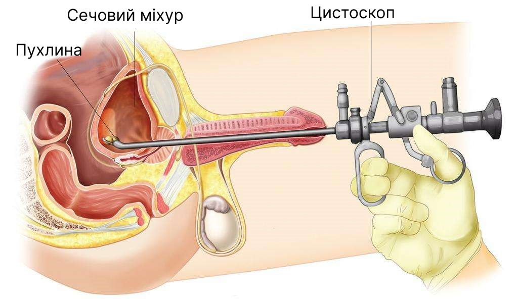 У яких випадках показано цистоскопічне дослідження