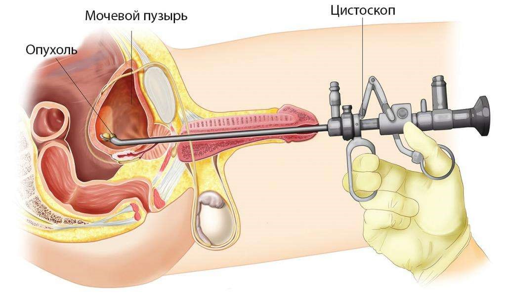 В каких случаях показано цистоскопическое исследование