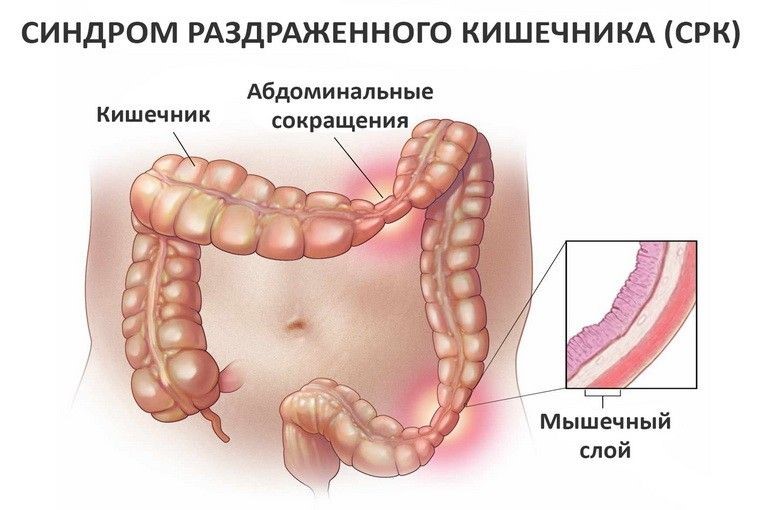 Лечение раздраженного кишечника