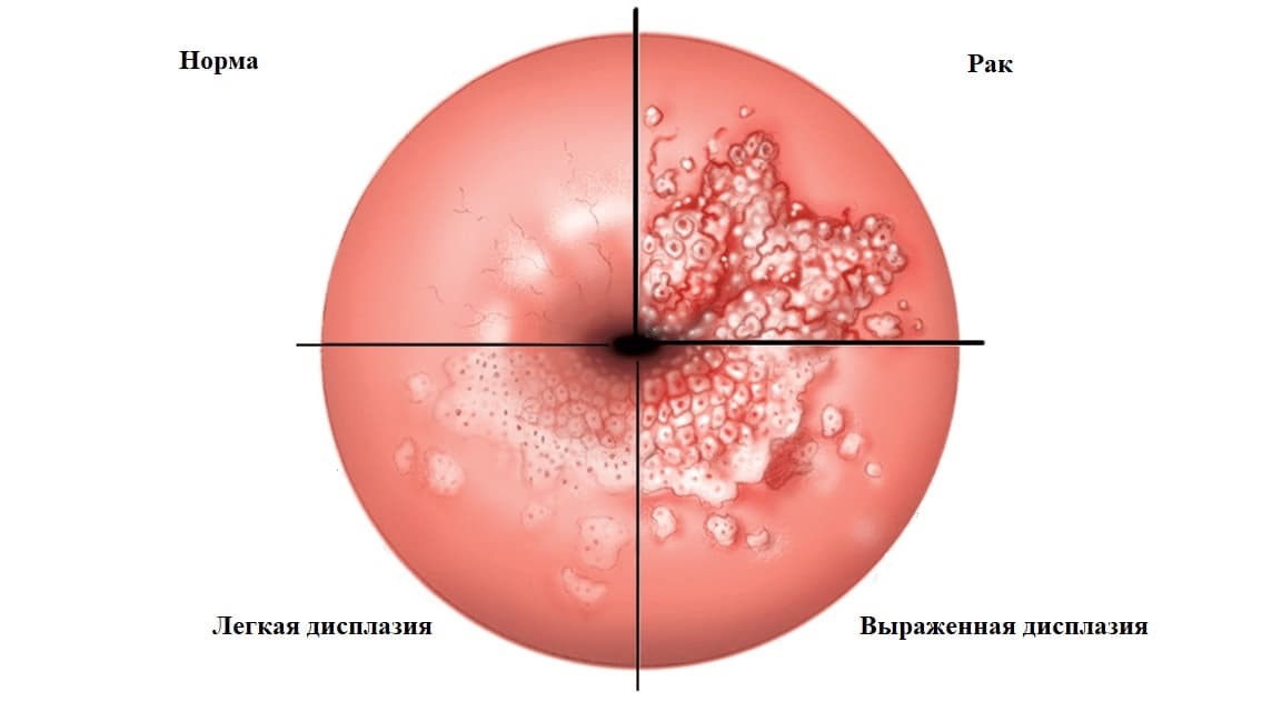 Лечение дисплазии шейки матки