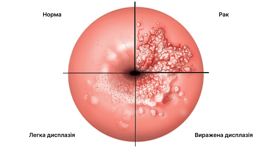 Лікування дисплазії шийки матки