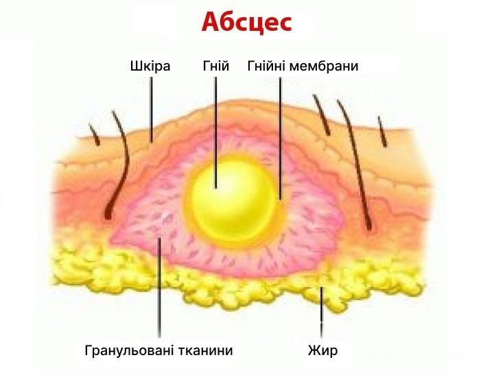 Абсцес