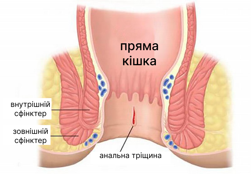 анальная трещина