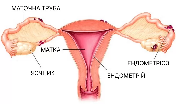 АБЛЯЦІЯ ТА РЕЗЕКЦІЯ ЕНДОМЕТРІЮ