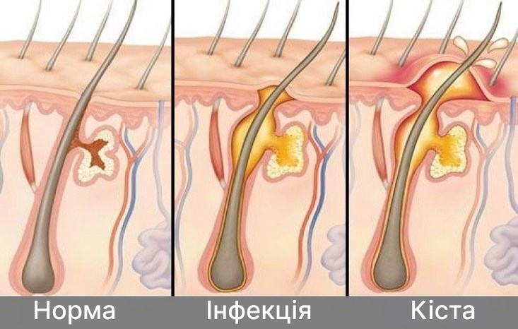 Вилучення Кісти Копчика