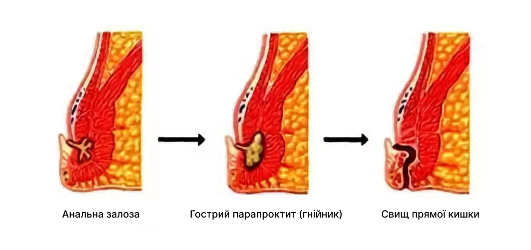 парапроктит лечение