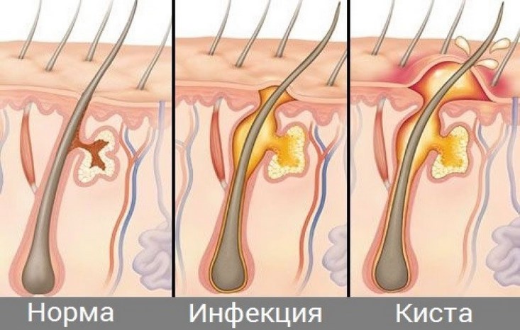 Удаление кисты копчика