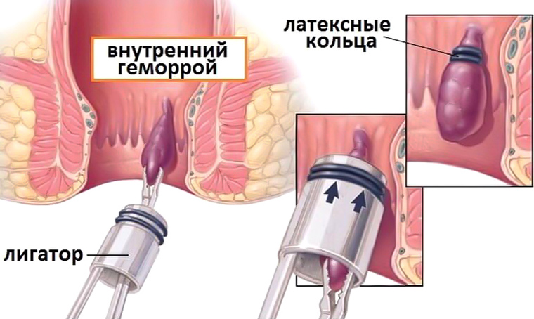 Преимущества наложение колец