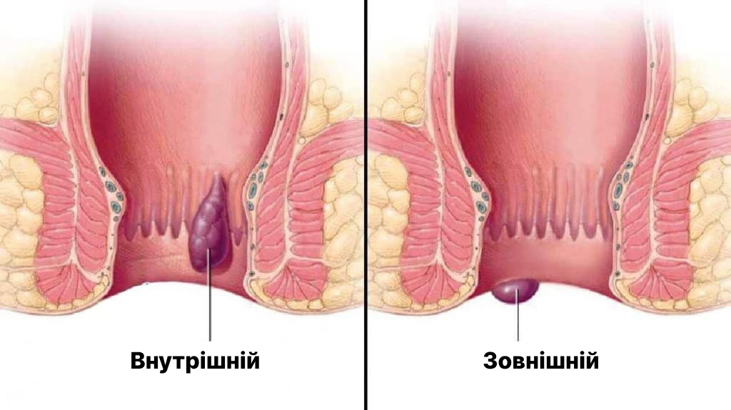 Різновиди геморою