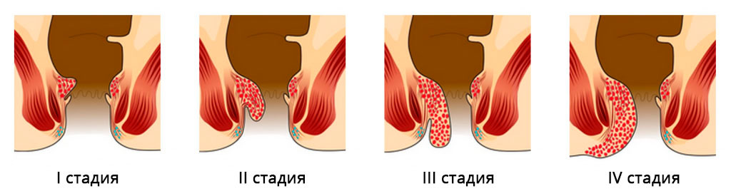 Диагностика и лечение геморроя