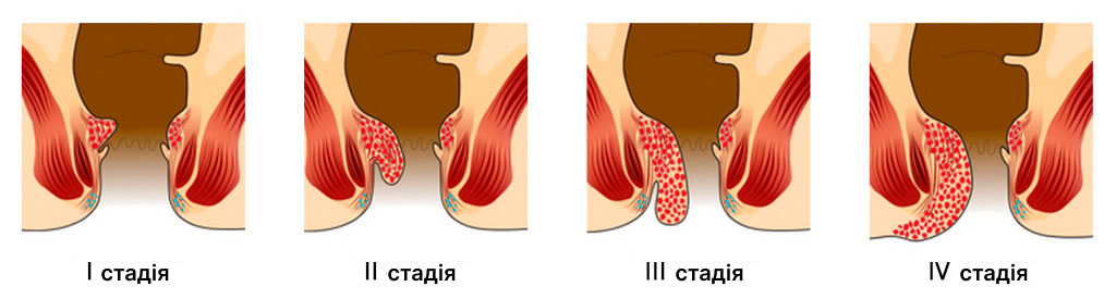 стадии развития геммороя