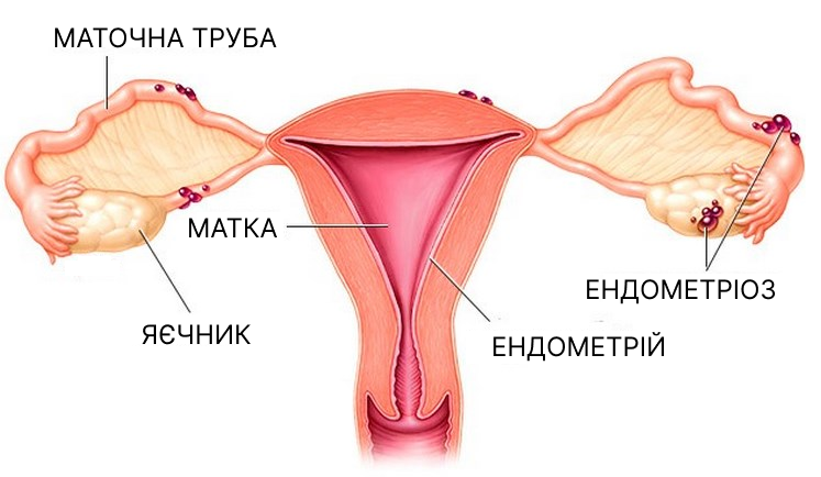 Лікування ендометріозу