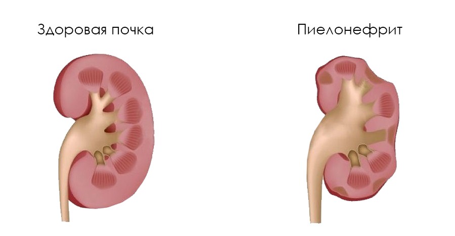 Воспаление в почках