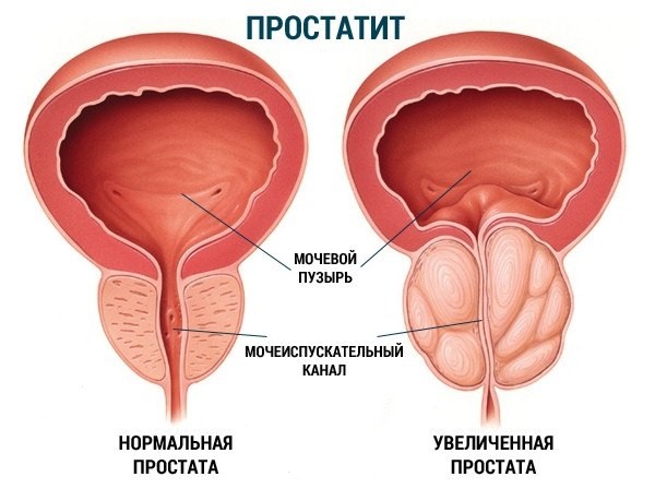 Виды простатита