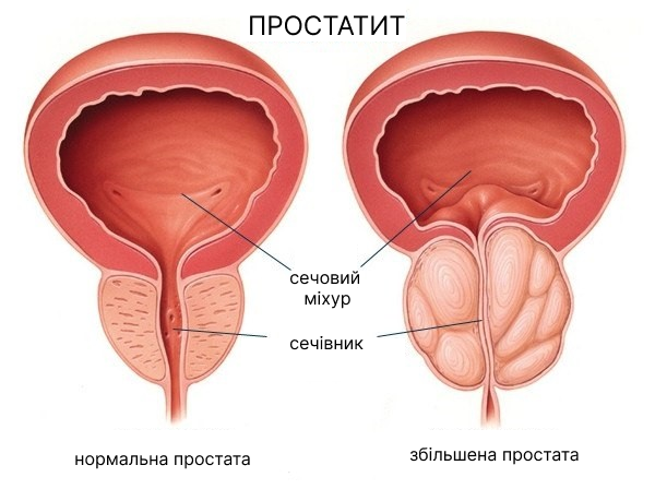 Види простатиту