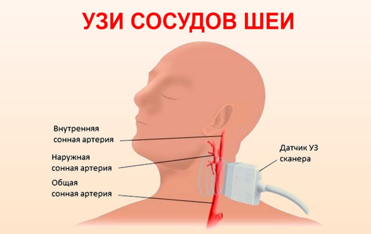 Развернутое УЗИ сосудов головы и шеи в медицинском центре «МЕДИКОМ  КРИВБАСС» | mkom